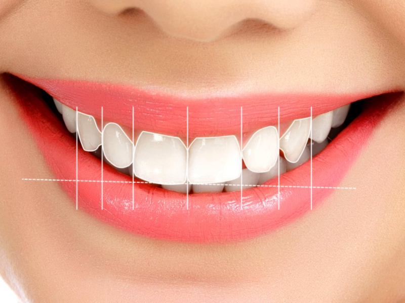 Estetik Gülüş Tasarımı - Set Dent Ağız ve Diş Sağlığı Polikliniği - SET Dent Clinic
